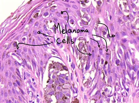 46. Melanocytic nevus and superficially spreading melanoma – greek.doctor