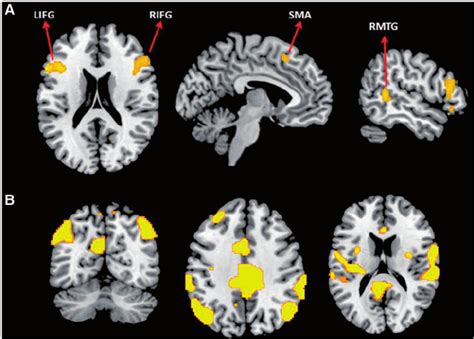 Superior Frontal Gyrus Mri