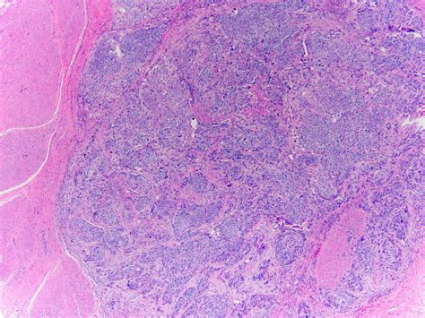 Invasive Urothelial Carcinoma