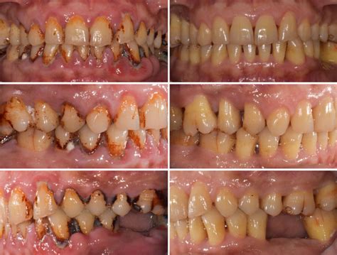 Generalised Moderate-Advanced Chronic Periodontitis | ADS