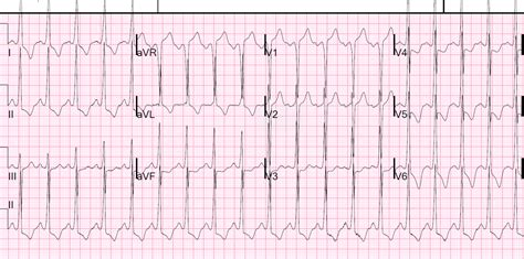 Dr. Smith's ECG Blog: History of Hypertrophic Cardiomyopathy (HOCM ...