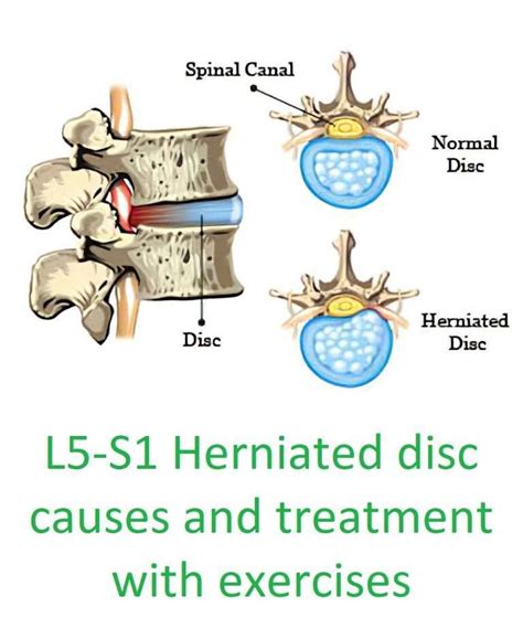 L5-S1 Herniated disc relief with 3 exercises to avoid surgery