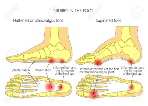 Injuries in the foot: plantar fasciitis, heel spur and sesamoidit. Used: gradient, transparency ...