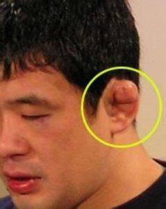 Swollen Ear Lobe Causes, Picture, Itchy, Red, No Reason, Lymph Nodes, Infection, Piercing ...