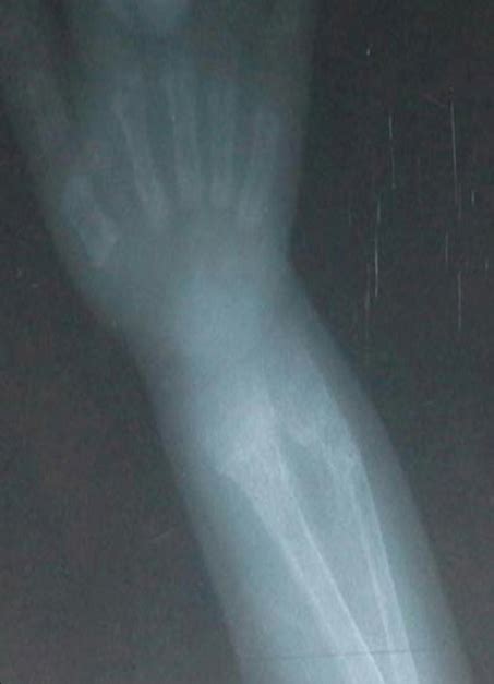 X-Ray of the Radius and Ulna Showing Hypophosphatemic Rickets With ...