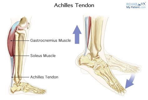 Achilles Tendon Rupture | Rehab My Patient