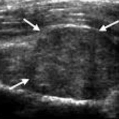 Elbow (Olecranon) Bursitis - Dr. Gustavo Armando Tafoya Arreguín