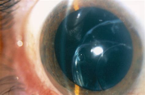 Surgical treatment of a dislocated intraocular lens–capsular ...