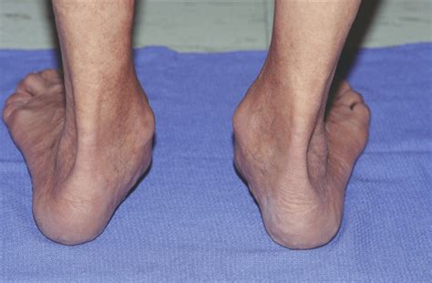 Adult Acquired Flat Foot: Posterior Tibialis Tendon Dysfunction | Kintec