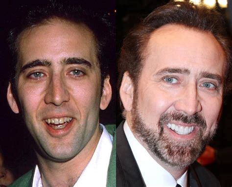 Nicolas Cage - Celebrity teeth - before & after - Digital Spy