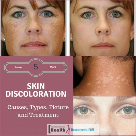 Skin Discoloration : Causes, Types, Picture And Treatment