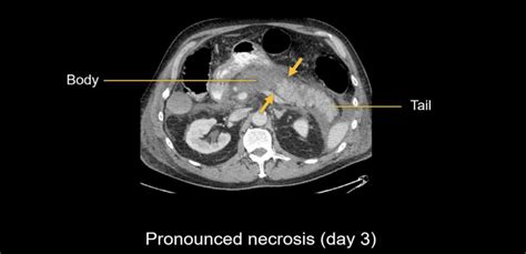 Abdominal CT: necrotizing pancreatitis • LITFL • Radiology Library