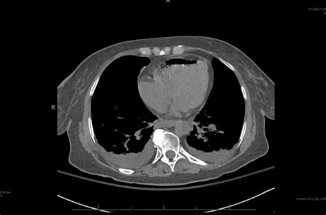 Air Embolism – Core EM