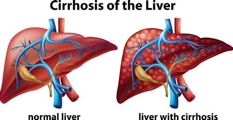 Ascites, advanced liver disease indicator for liver cirrhosis