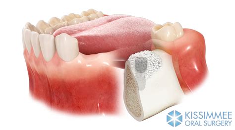 Ridge Augmentation - Raphael A. Ason, DMD, MD