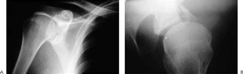 6. Glenoid Rim Fractures | Musculoskeletal Key