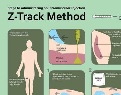 Rebecca Janus - Z-Track Procedure