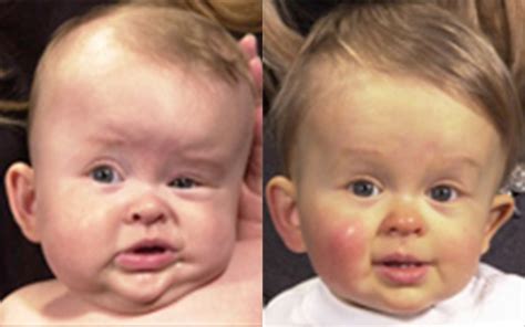 Craniosynostosis Before & After Pictures Dallas, Plano, TX