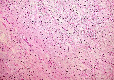 Odontogenic Myxoma Histology