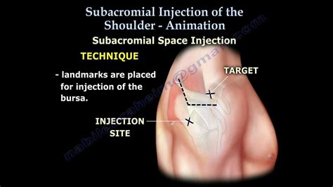 Shoulder bursitis, Tendonitis Injection Animation - Everything You Need ...