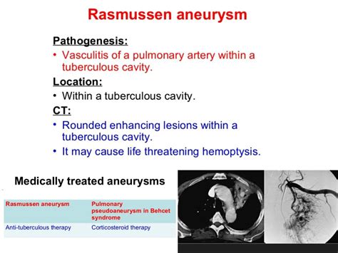 Rasmussen aneurysm