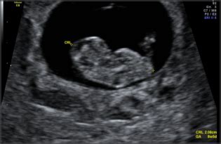 Ultrasound At 8 Weeks - radiologystar