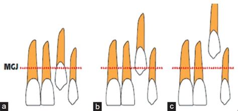 Recommended surgical techniques relative to the mucogingival junction ...