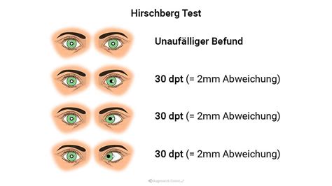 Hirschberg -Test | Lexikon der Augenheilkunde