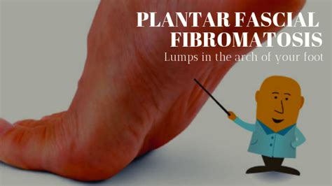 19+ Plantar Fibroma Massage - HoaiSargon