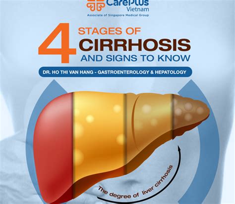 What Are The 4 Stages Of Cirrhosis Of The Liver: A Comprehensive Guide