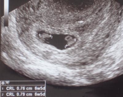 7 Week Ultrasound...Identical or Fraternal?