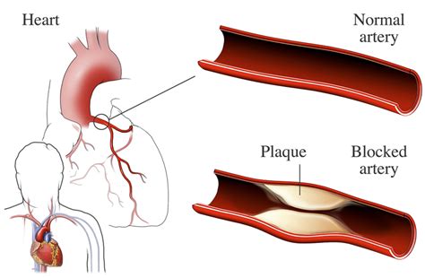 Ischemic Heart Disease | National Heart, Lung, and Blood Institute (NHLBI)