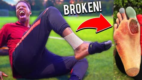 NFL Football: What Pro Football Player Broke His Leg Today