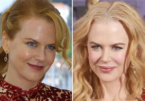 Nicole Kidman Plastic Surgery Before and After Botox Injections | Celebie