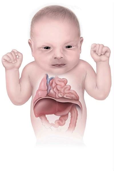 Congenital diaphragmatic hernia: MedlinePlus Genetics