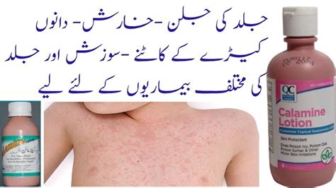 Calamine lotion Uses and side effects in Urdu Hindi. calamine lotion benefits. Allergies Itching ...