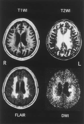 Diffusion-Weighted MRI in Severe Leukoaraiosis | Stroke