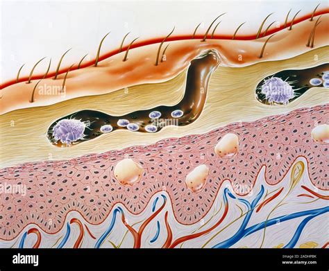 Los ácaros de la sarna excavando en la capa superior (epidermis) de la piel humana ...