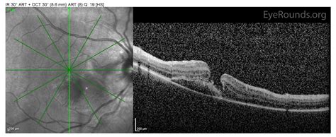 Atlas Entry - Choroidal rupture