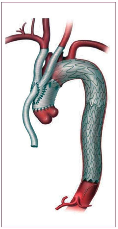 Aortic Dissection Stent