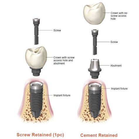 serious post. what is a tooth implant like? - Pelican Parts Forums