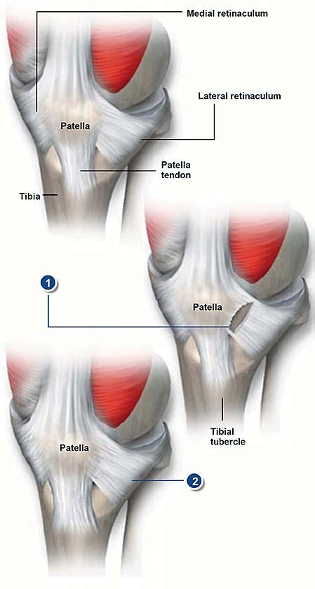 Lateral Release and Medial Imbrication | Central Coast Orthopedic Medical Group