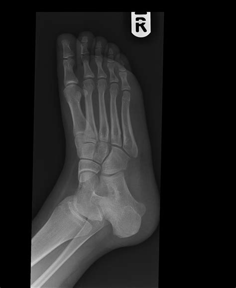 Daily Dose: cuboid fracture