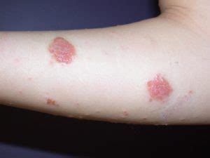 Discoid eczema | National Eczema Society