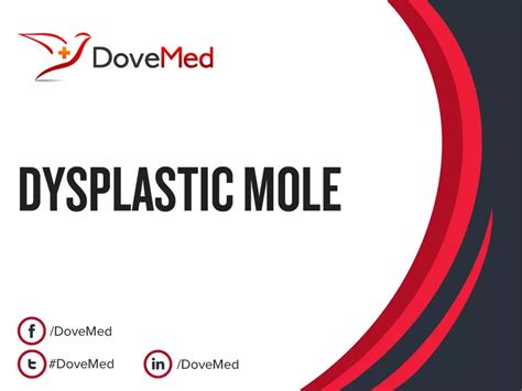 Dysplastic Mole - DoveMed