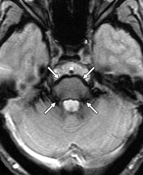 American Journal of Roentgenology (AJR) | Radiology, Neurology, Brain images