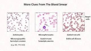 Megaloblastic Anemia Peripheral Smear