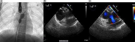 Platypnea–orthodeoxia syndrome in a child: relief of symptoms after ...