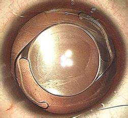 Intraocular Lens Implant (IOL) - American Association for Pediatric ...