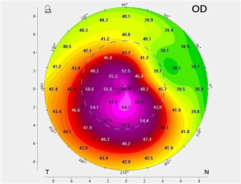 How is keratoconus discovered? - The ELZA Institute